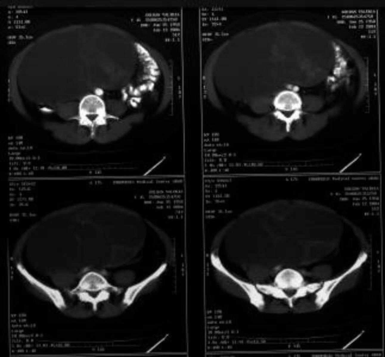 poza despre chist ovarian